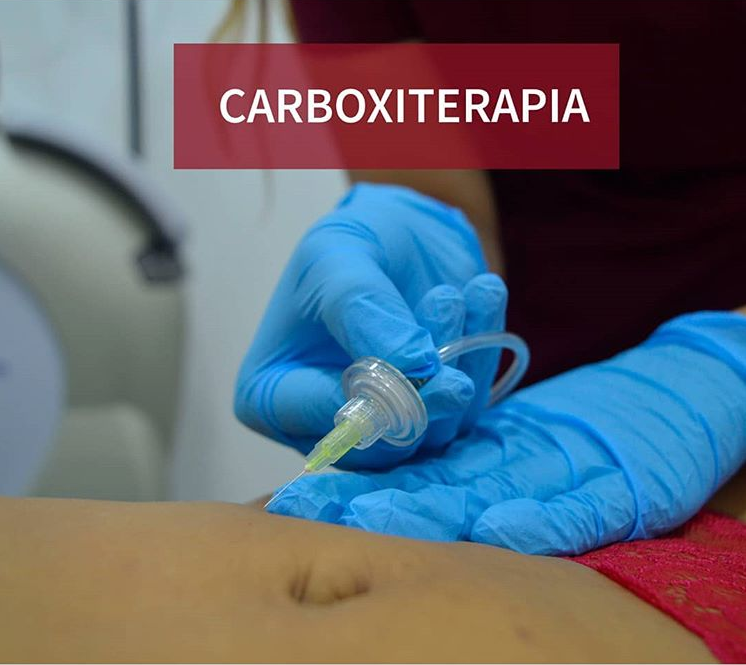 Carboxiterapia en Barcelona (beneficios del tratamiento)