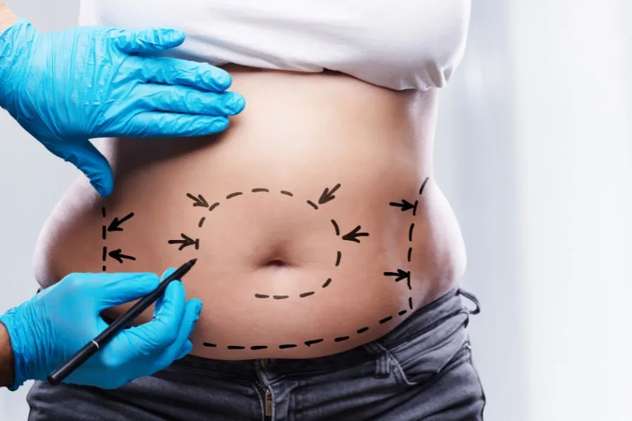 lipofilling