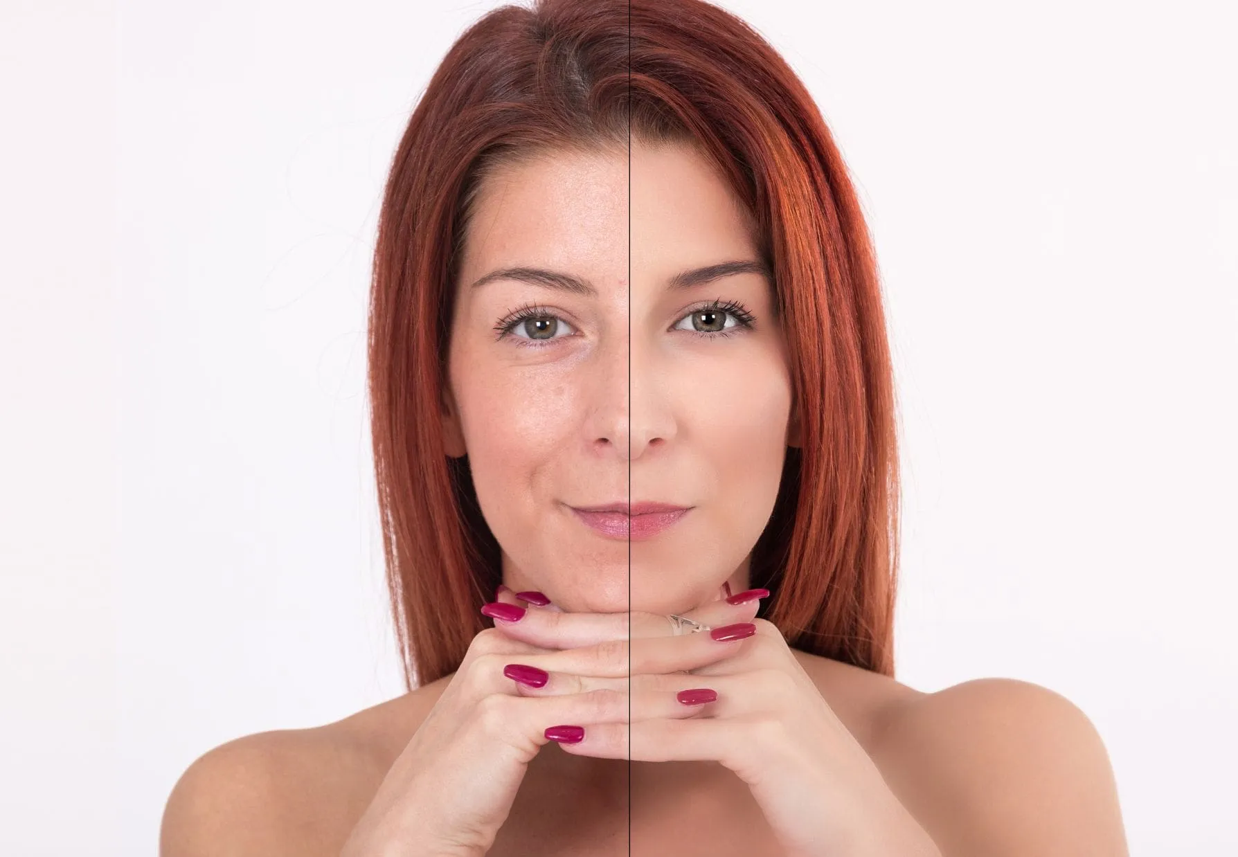 armonizacion facial bcnclinic