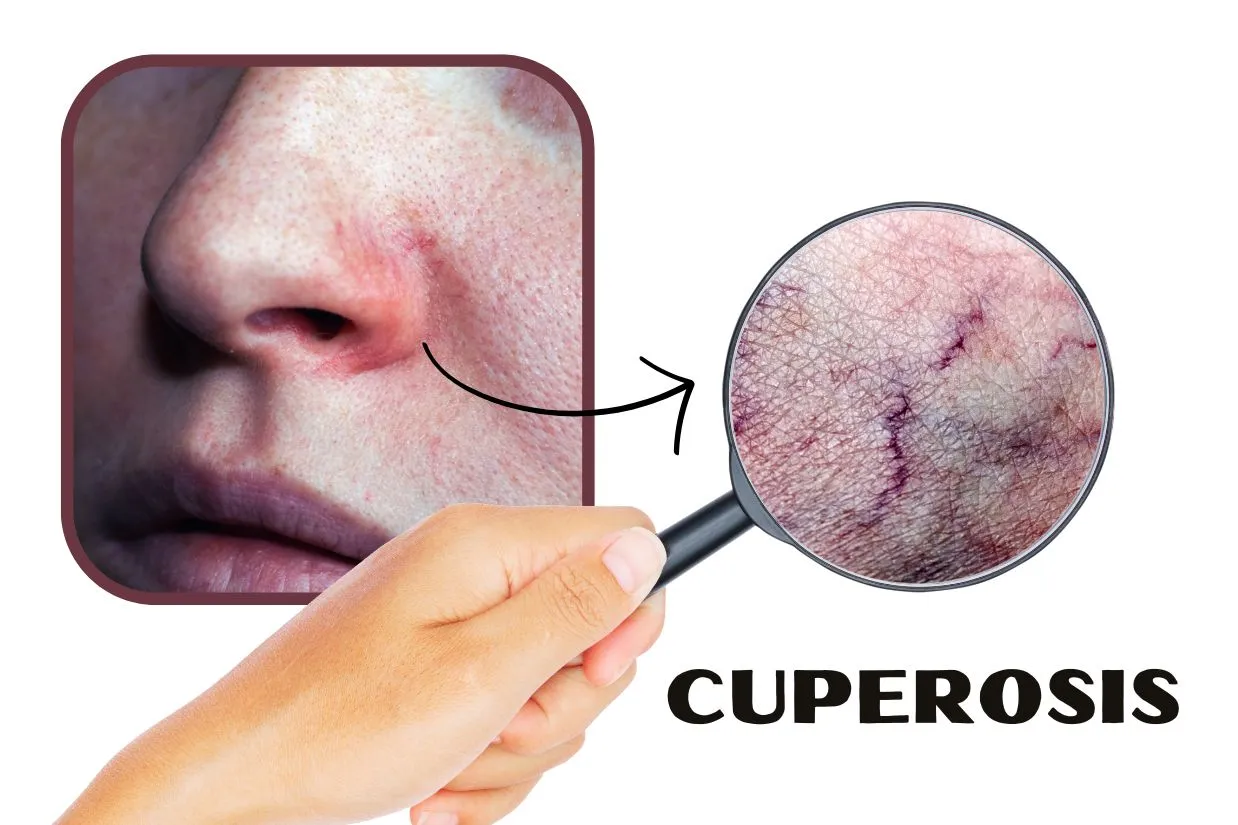 Tratamiento cuperosis