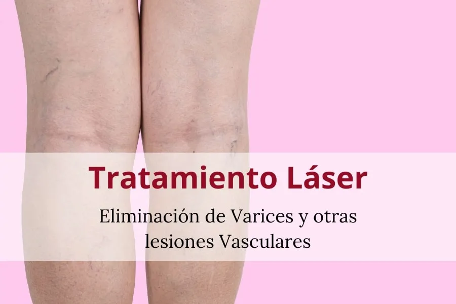 Láser eliminar varices