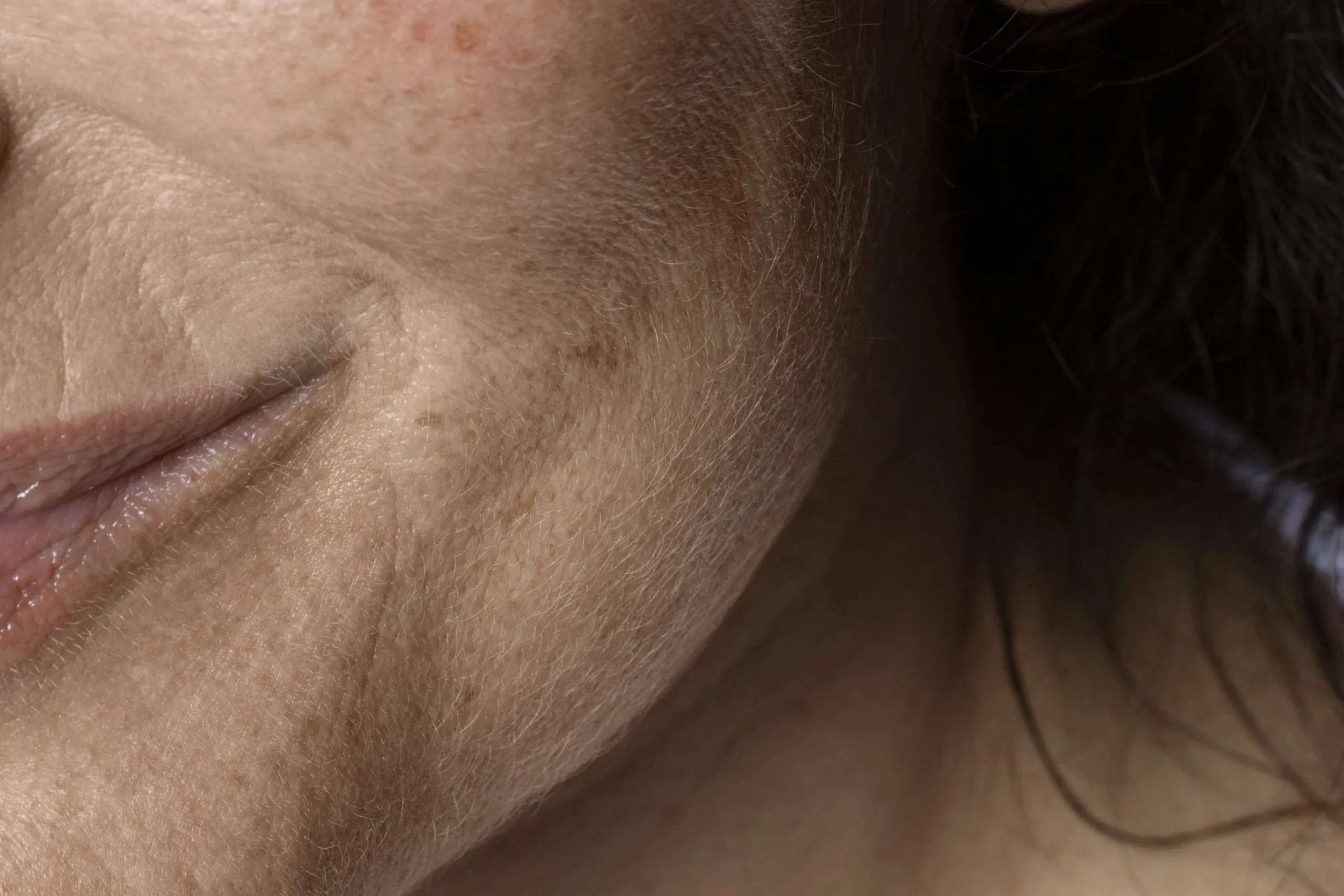 Tratamientos para Quitar Manchas en BCNClinic