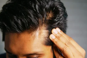 Síntomas de alopecia