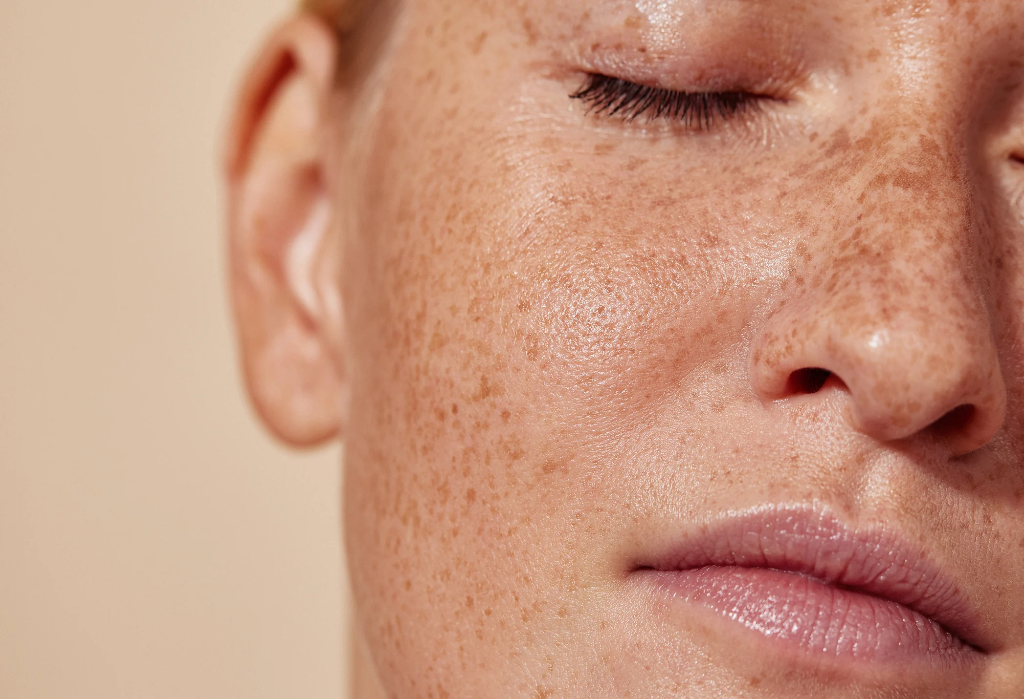 Mujer con manchas de melasma en la cara