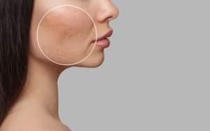 Tratamiento cicatrices acné láser fraccionado BCNClinic Barcelona mostrando técnica profesional eliminar marcas acné piel textura irregular