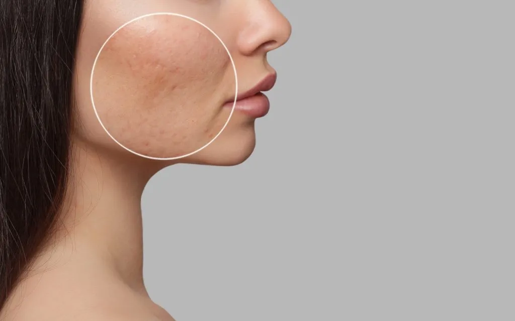 Tratamiento cicatrices acné láser fraccionado BCNClinic Barcelona mostrando técnica profesional eliminar marcas acné piel textura irregular