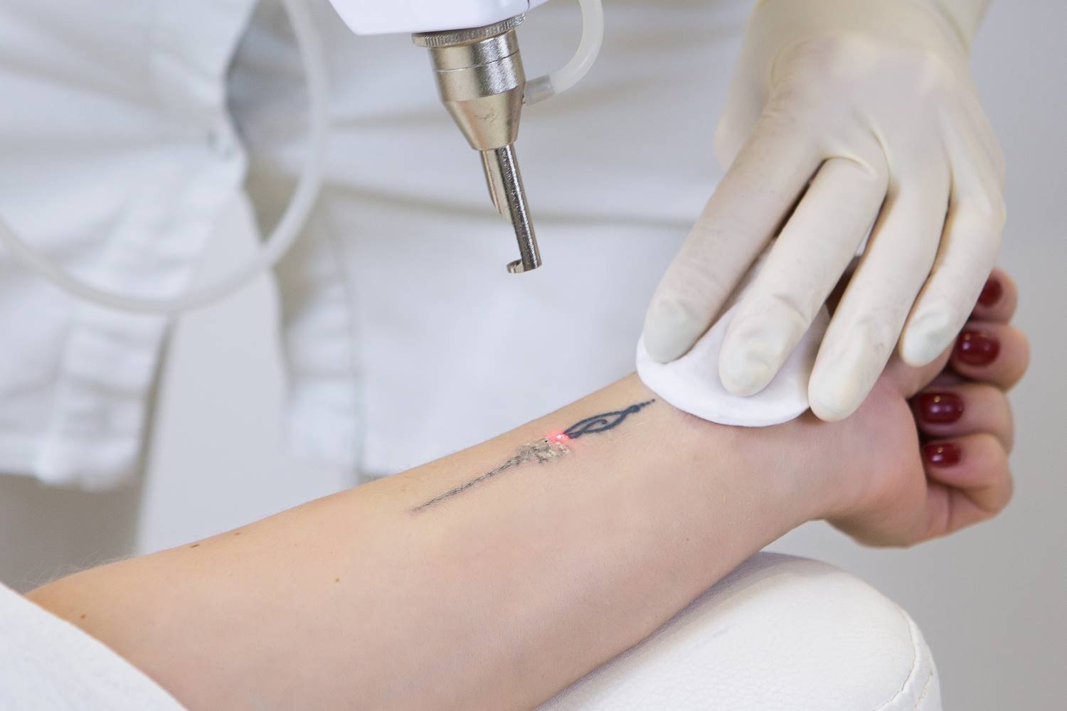 Tratamiento eliminación tatuaje láser Q-Switched profesional en clínica estética BCNClinic Barcelona mostrando proceso seguro efectivo